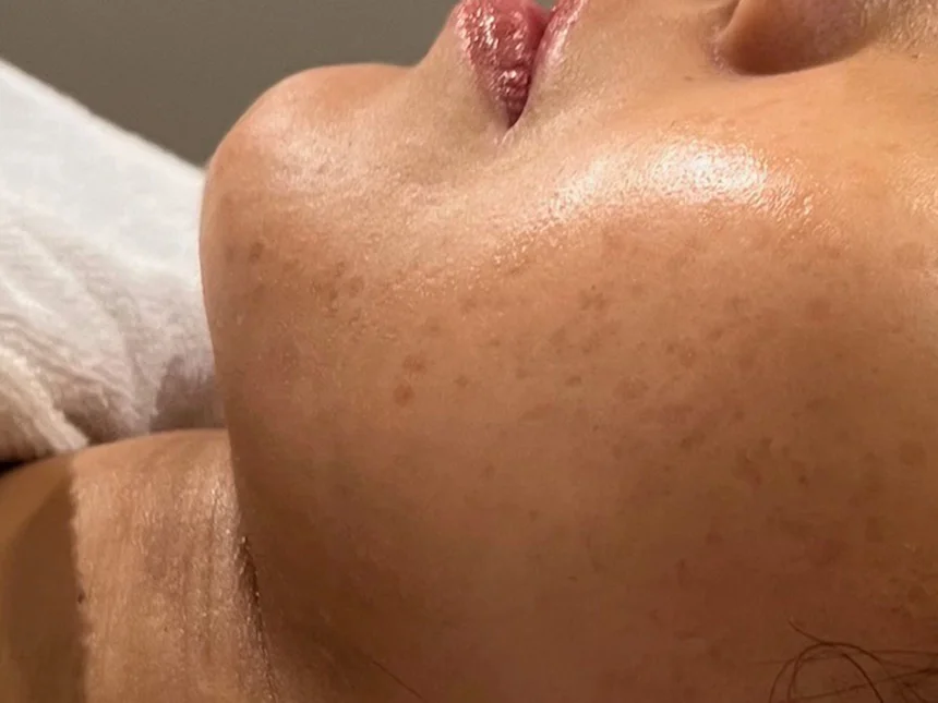 脂肪燃焼フェイスライン 施術前