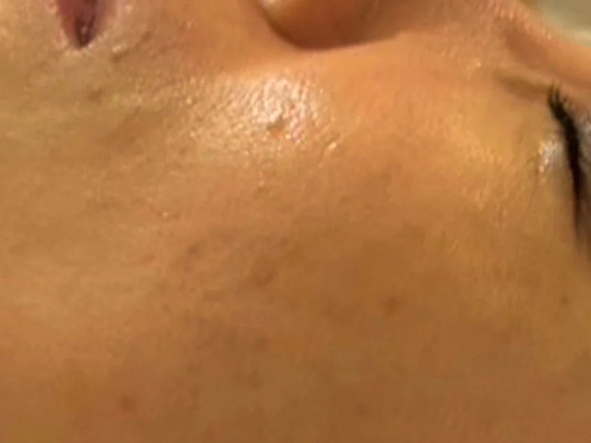 ニキビケア 施術後