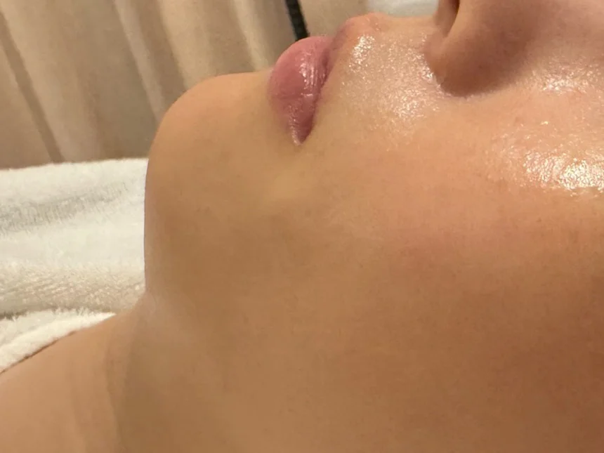 リフトアップ 施術後