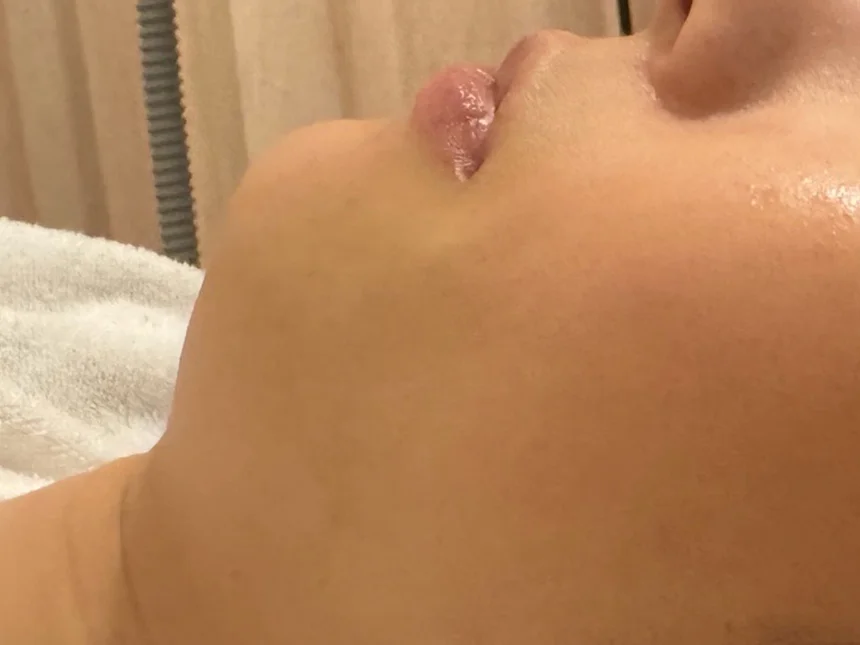 リフトアップ 施術前