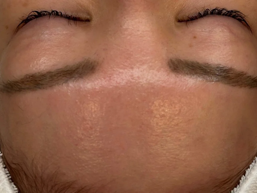 水分量アップ 施術前